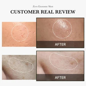 Medicube One Day Exosome Shot Pore Ampoule 2000 - 30ml - product benefit image 3