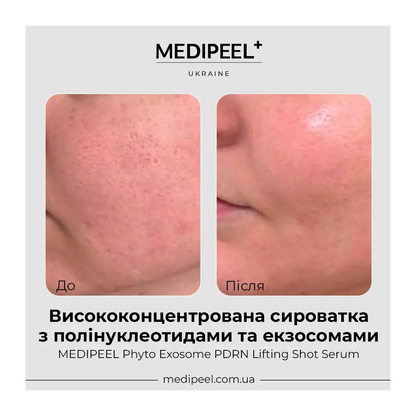 MEDI-PEEL Phyto Exosome PDRN Lifting Shot Serum — helps firm and tighten for a sculpted look